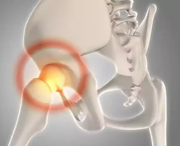 Hip Resurfacing
