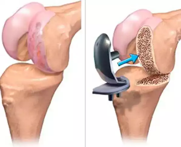 Half Knee Prosthesis
