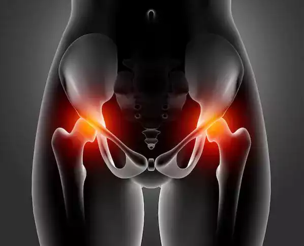 Hip Prosthesis for Hip Dislocation
