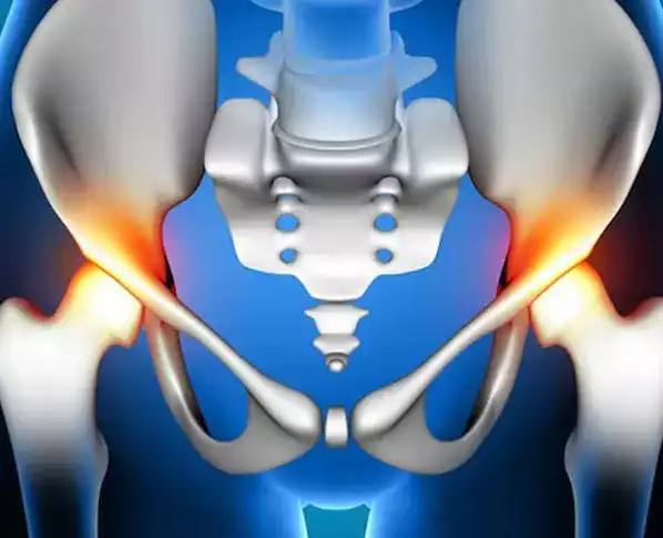 Hip Prosthesis
