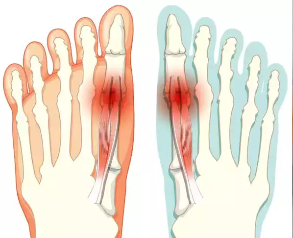 Halluks Valgus